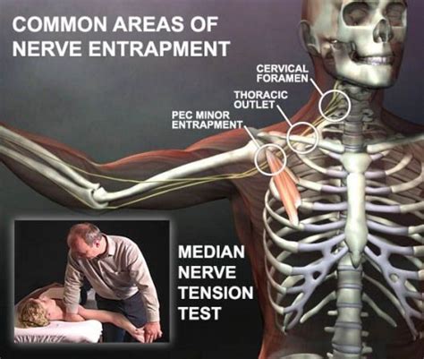 test for nerve compression|how to diagnose pinched nerve.